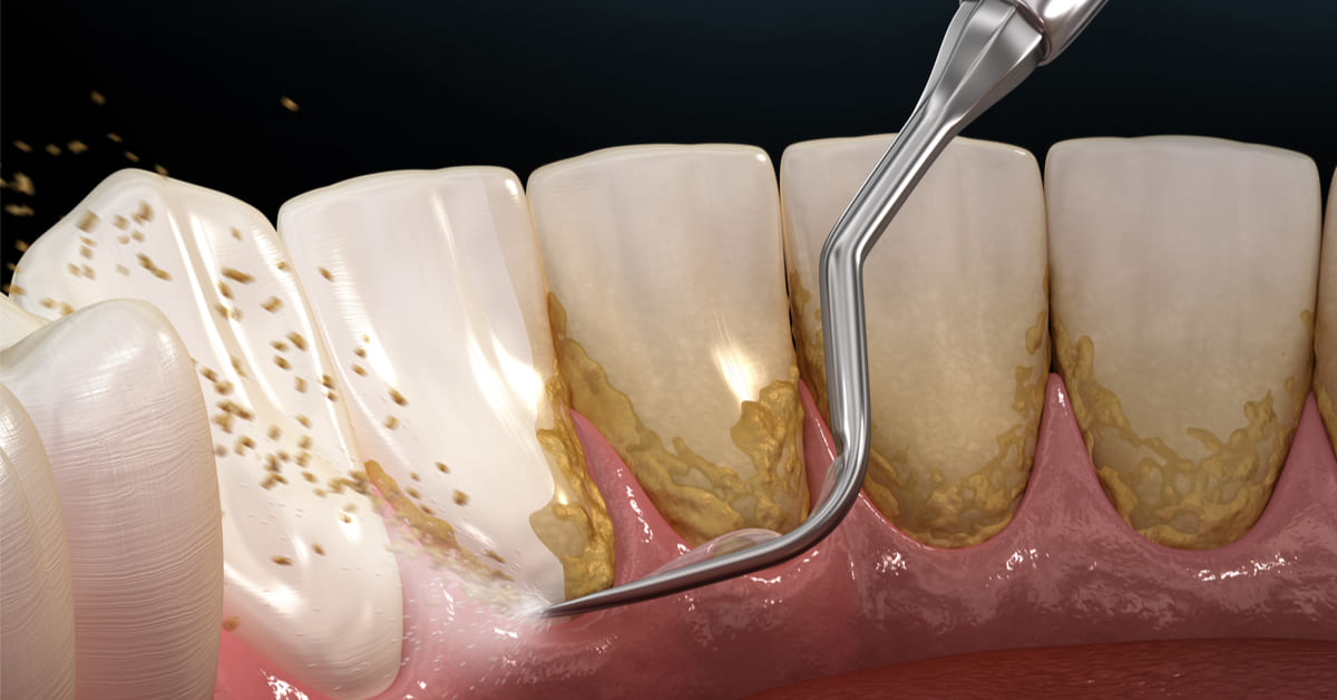 تنظيف الأسنان , تنظيف أسنان , تجميل الاسنان , ابتسامة هوليوود , تبييض الأسنان